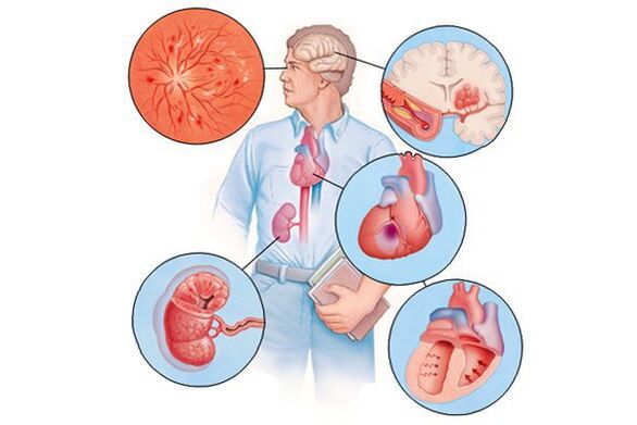 Daño a varios órganos con hipertensión arterial prolongada
